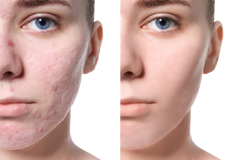 BNB Acne Control Kit