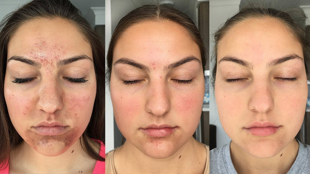 BNB Acne Control Kit